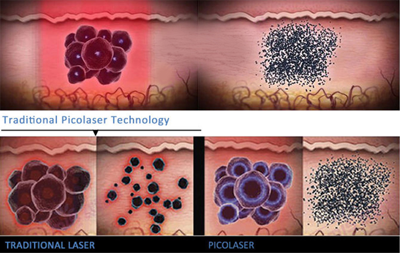 picosecond laser work theory