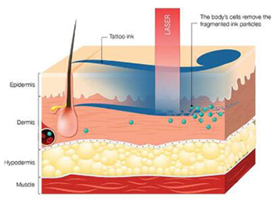 tattoo removal theory