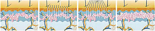1550 նմ էրբիումային մանրաթելային լազեր
