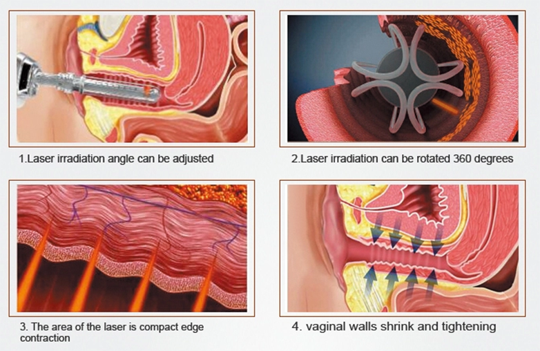 VAGINAL KUSIMBISA CO2 LASER