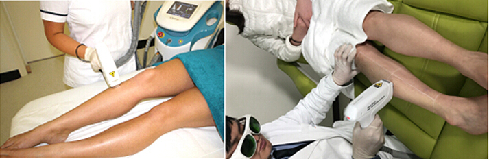 diode laser hair removal-6