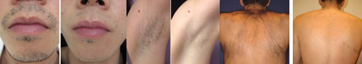 diode laser hair removal-7