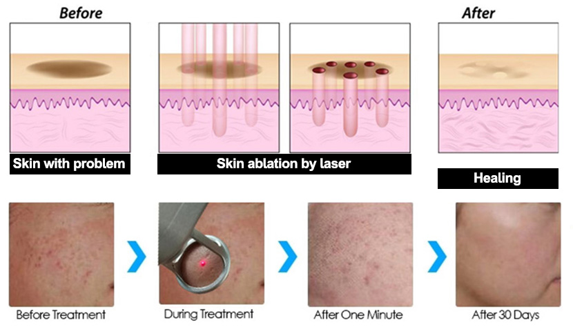 laser pecahan CO2