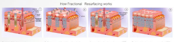 fractional laser-7